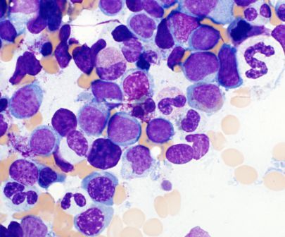 Bone marrow aspirate: dysgranulopoiesis